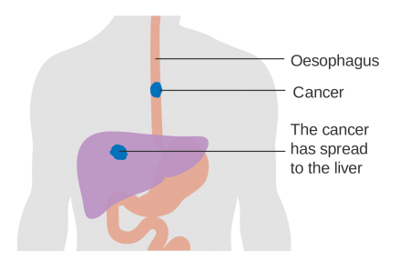 oesophageal_cancer.png