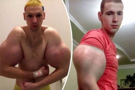 man-who-injected-his-arms-with-chemical-to-look-big-shocks-with-a-new-look-photos.jpg