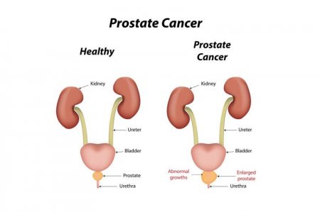 Prostate-Cancer - nigeria metro news - thisday live news.jpg