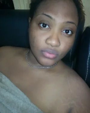 stretch marks.webp