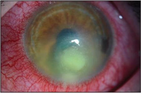 contact-lens-infection.jpg