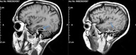 036-seizures-cotton-bud-abscesses_600.jpg