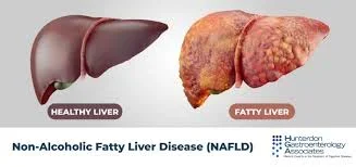 fatty liver.webp