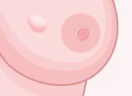 breast cancer.webp