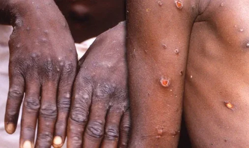 monkey pox.webp