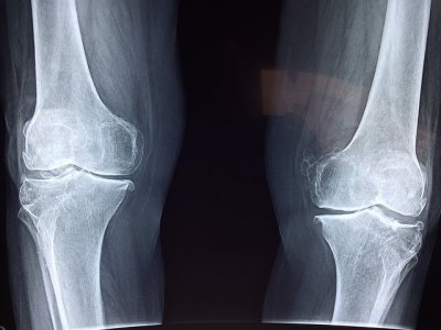 From Relief to Horror: Woman Discovers Surgeons Operated on the Wrong Knee
