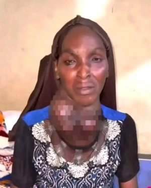 Osun Woman Rejects Free Goiter Surgery, Requests N300k Support