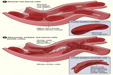 FDA Approves Groundbreaking CRISPR-Based Treatment, Offering Hope to Sickle Cell Patients