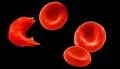 sickle cell.webp