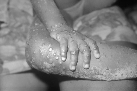 Mpox Update: Nigeria Records 39 Cases, NCDC Boosts Monitoring Efforts