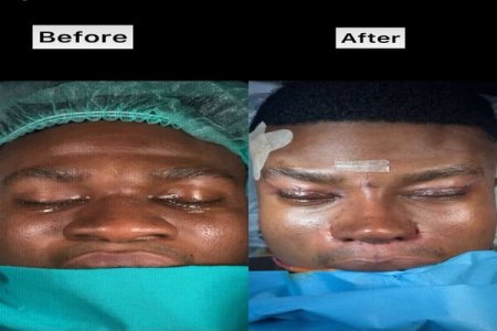 Comedian Zicsaloma Celebrates Dream Nose After Successful Surgery in Turkey