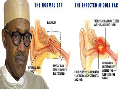 Buhari-Ear-Problems.jpg