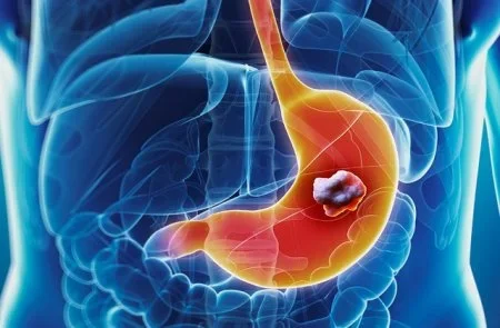stomach cancer.webp