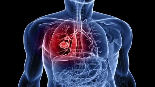 lung cancer.webp